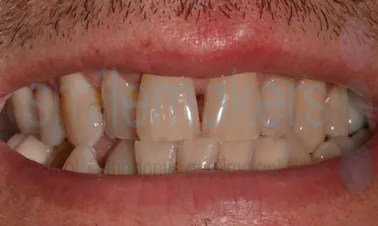 A closeup of two front teeth, with the one on the right having been filled in but is now discoloured