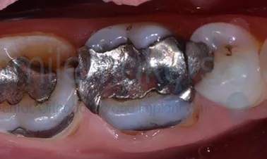 teeth with metal fillings